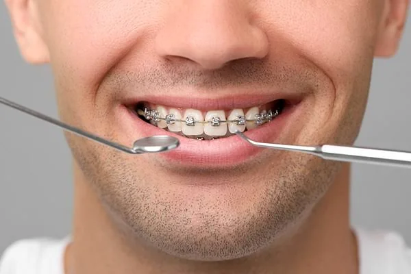 Orthodontic Treatment – Braces