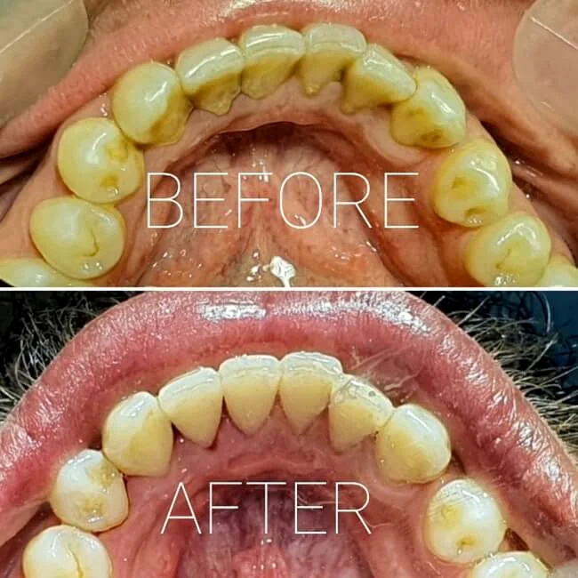 Scaling & Polishing