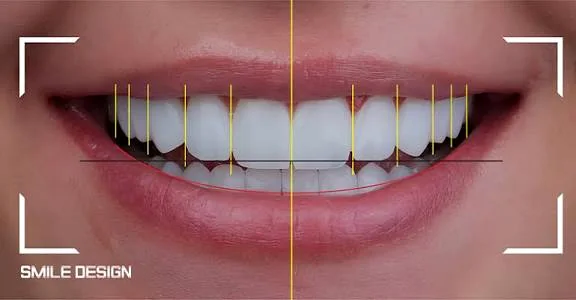 Digital Smile Design
