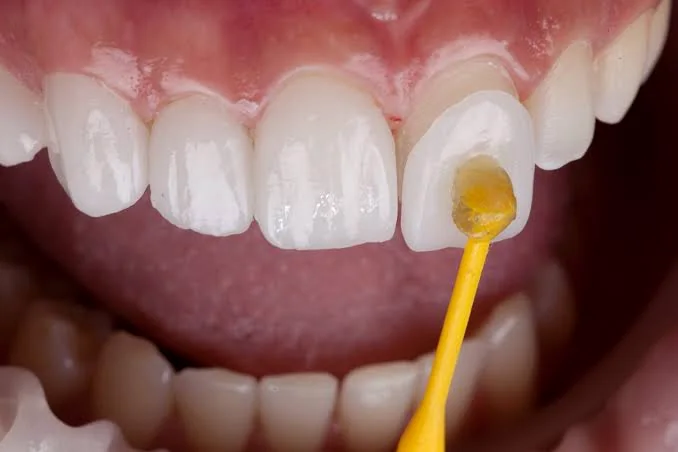 Dental Veneers